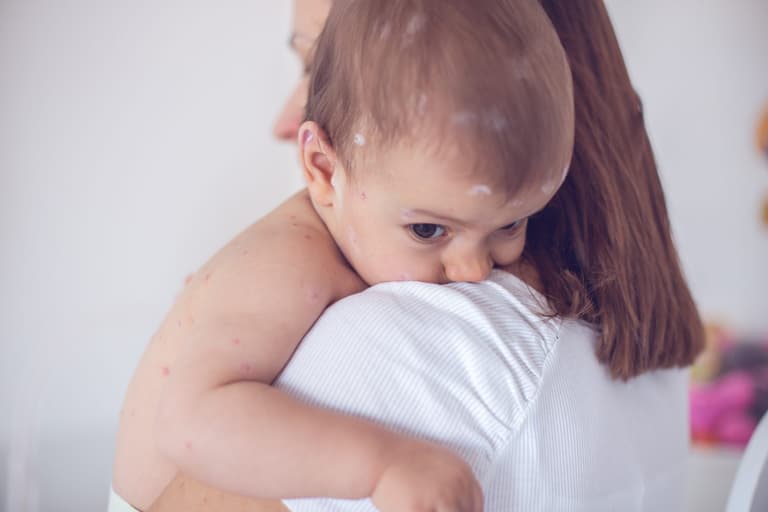 Should you go to work if your child has chickenpox? All you need to know