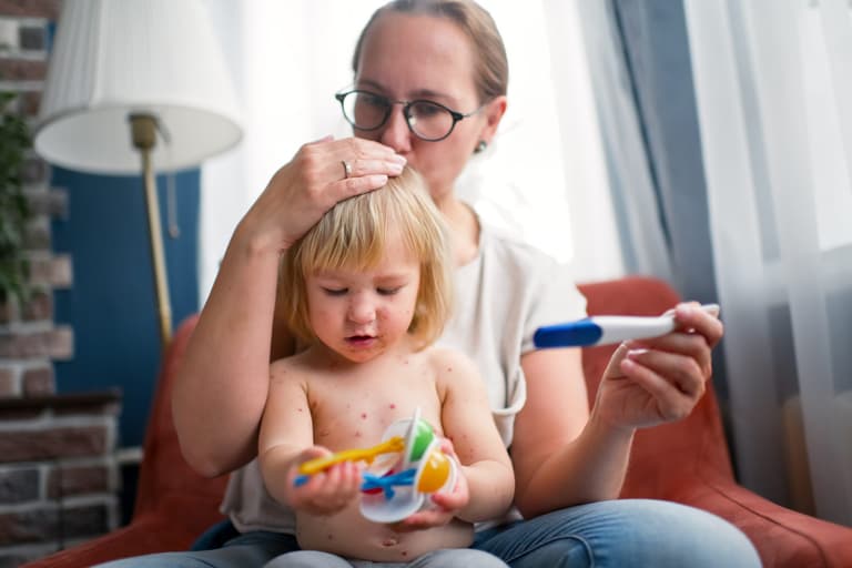 Three lesser known symptoms of Chickenpox in children Three lesser known symptoms of Chickenpox in children