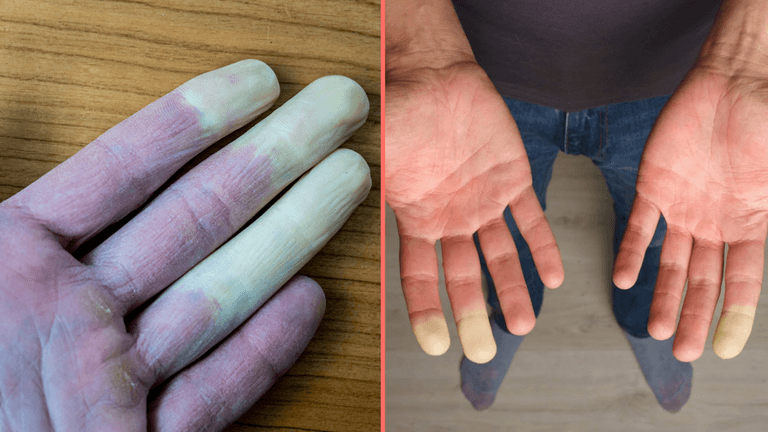 Millions of women suffer common disease where fingers turn white during winter months