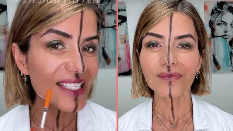 Doctor reveals the side effects of Botox after injecting only one side of her face Doctor reveals the side effects of Botox after injecting only one side of her face