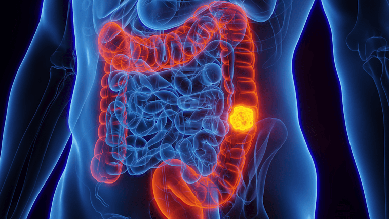 Doctor reveals what foods he saw in diets of 80% of colon cancer cases
