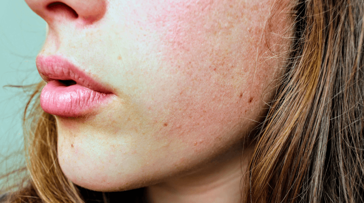 This is one of the best serums to use if you suffer from redness