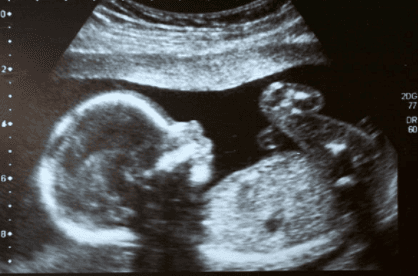 People are getting their ultrasound scans painted onto their nails