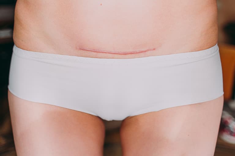 Viral video shows exactly what a person goes through when they have a c-section