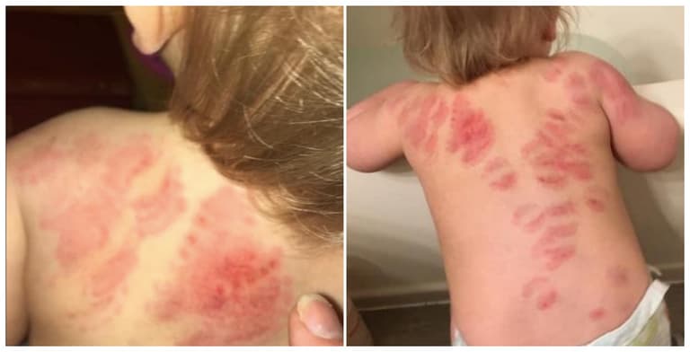 Horrified mum discovers her toddler is covered in bitemarks after a day in creche