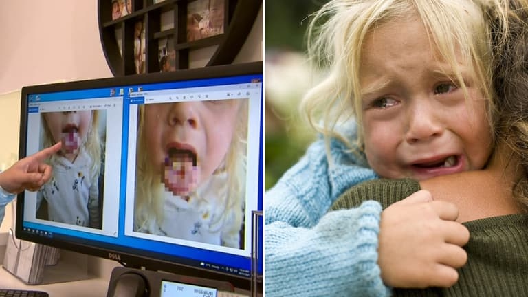 4-year-old girl burns hole in her tongue after eating sour sweets 4-year-old girl burns hole in her tongue after eating sour sweets