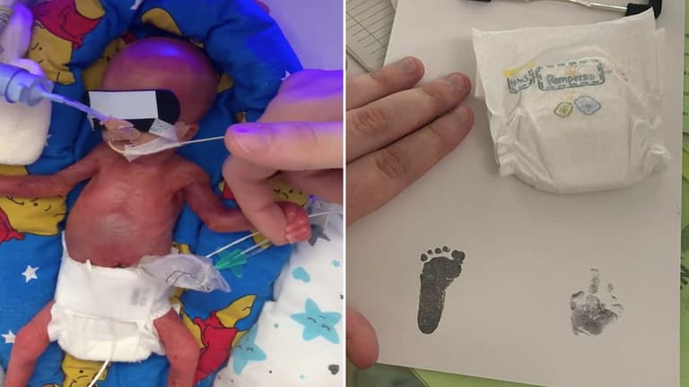 11oz baby becomes the smallest tot to survive in the UK 11oz baby becomes the smallest tot to survive in the UK