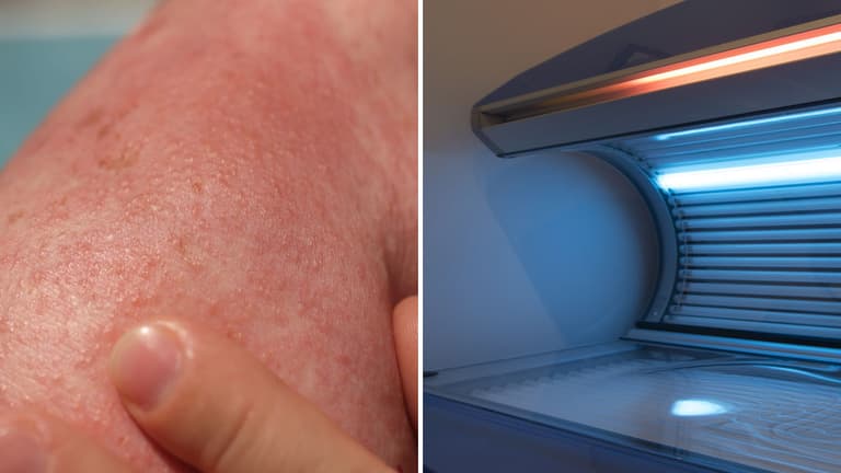 Sunbeds can emit UV radiation up to 5 times as strong as the Australian midday sun Sunbeds can emit UV radiation up to 5 times as strong as the Australian midday sun