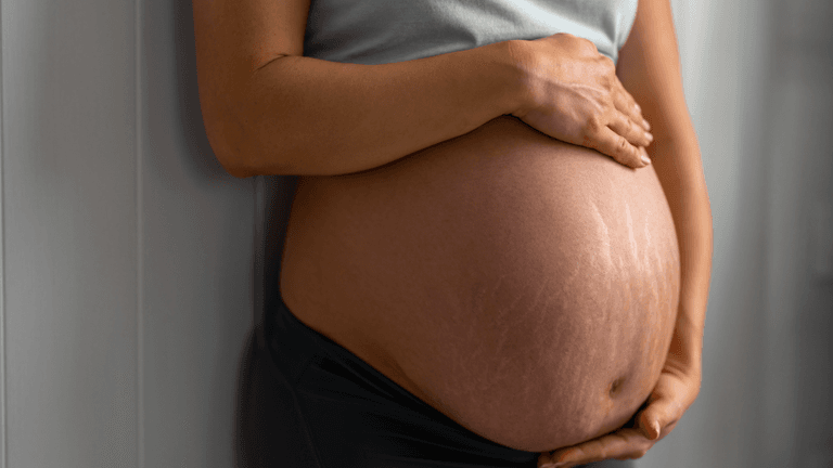 Can you prevent stretch marks in pregnancy? Can you prevent stretch marks in pregnancy?
