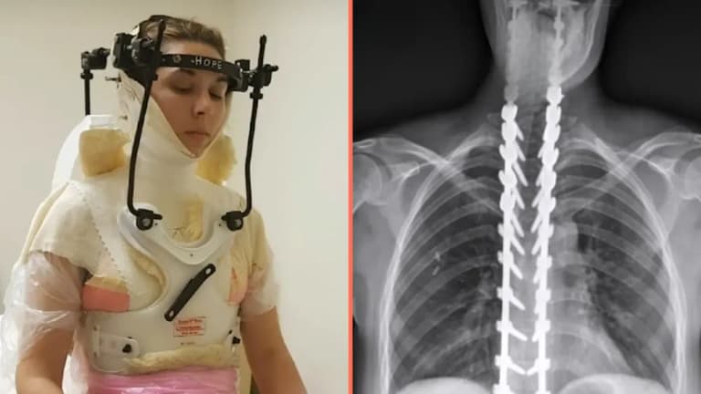 Woman has skull reattached after being ‘decapitated’ in freak football injury Woman has skull reattached after being ‘decapitated’ in freak football injury
