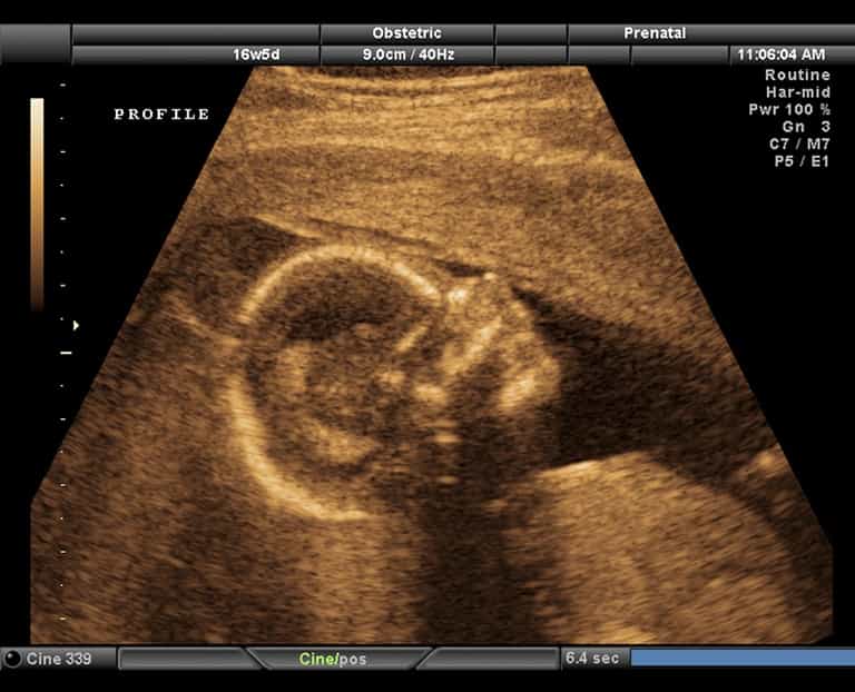 Ultrasound scan images reveal harmful effects of smoking during pregnancy Ultrasound scan images reveal harmful effects of smoking during pregnancy