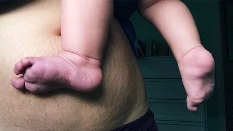 New mums post belly pics to show how AMAZING the female body is New mums post belly pics to show how AMAZING the female body is