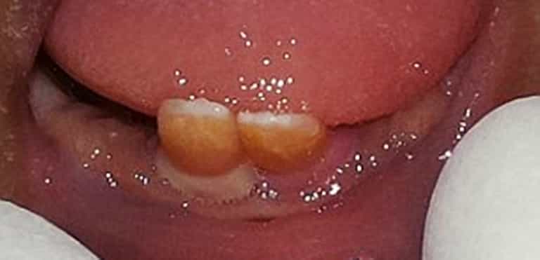 Twins BOTH born with front teeth, breastfeed anyway Twins BOTH born with front teeth, breastfeed anyway