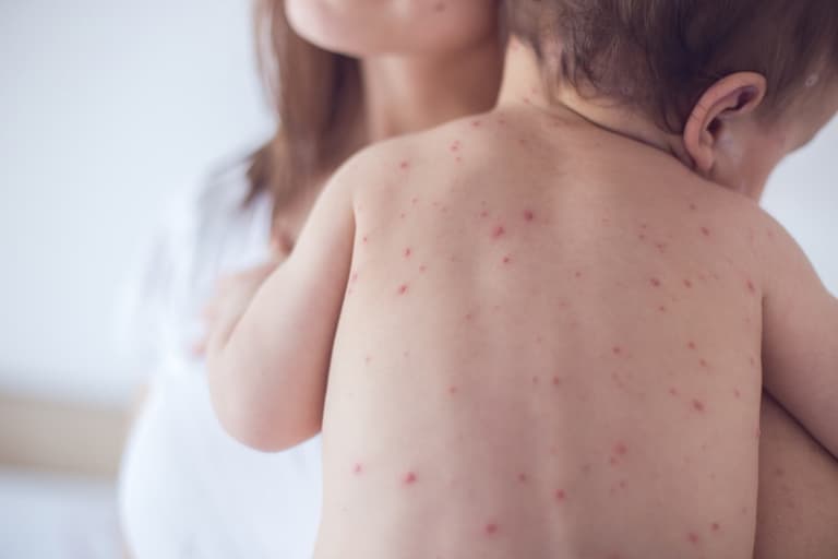 WHO warns of massive measles outbreak in Europe as more than 500 cases are reported in January WHO warns of massive measles outbreak in Europe as more than 500 cases are reported in January