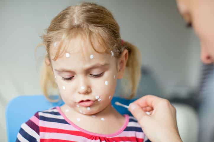 99 problems but an itch ain’t one? Now there’s a chicken pox park 99 problems but an itch ain’t one? Now there’s a chicken pox park