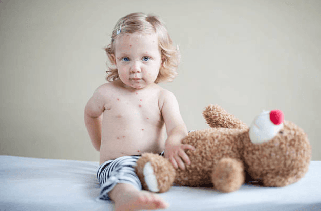 Measles warning issued to parents following outbreak in Europe Measles warning issued to parents following outbreak in Europe