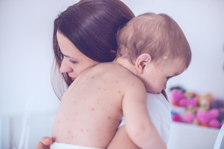 Things you should (and shouldn’t) do if your child gets a dose of chicken pox Things you should (and shouldn’t) do if your child gets a dose of chicken pox