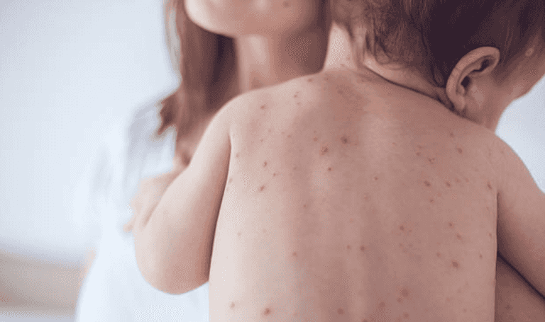 Measles: Symptoms to look out for and how it can be treated Measles: Symptoms to look out for and how it can be treated