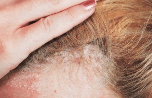 Woman claims her psoriasis disappeared after using €5.30 baby moisturiser Woman claims her psoriasis disappeared after using €5.30 baby moisturiser