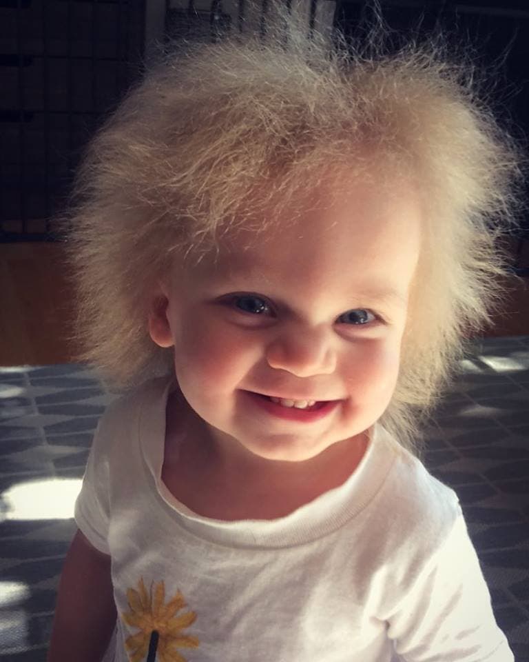 This adorable little girl has extremely rare hair and it’s absolutely amazing This adorable little girl has extremely rare hair and it’s absolutely amazing
