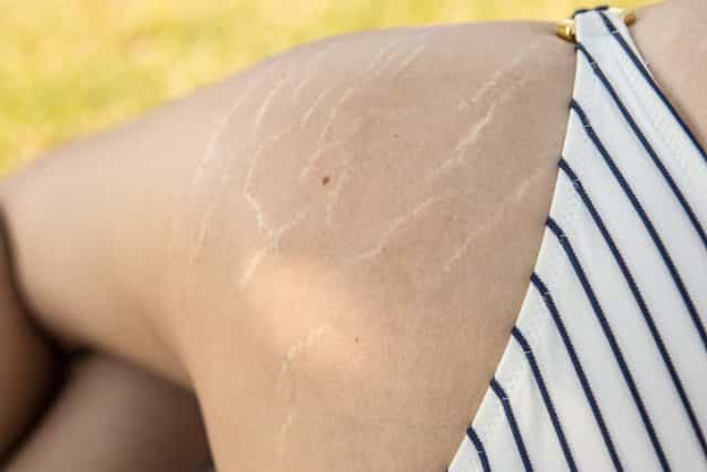 This amazing tattoo artist is covering stretch marks with skin-coloured ink This amazing tattoo artist is covering stretch marks with skin-coloured ink