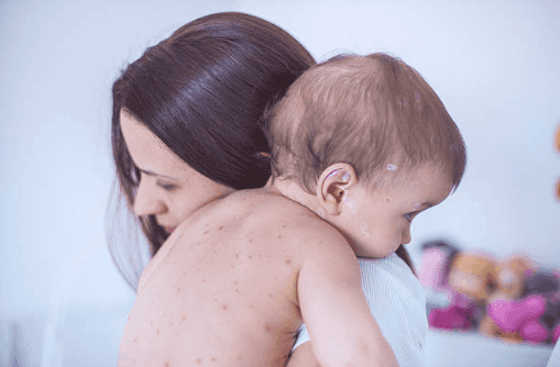 Early symptoms of measles as health officials warn of another rise in cases in Ireland Early symptoms of measles as health officials warn of another rise in cases in Ireland
