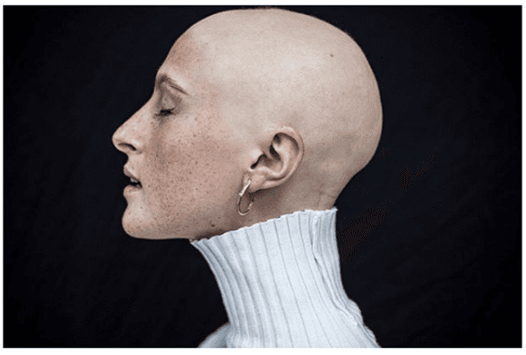 Stunning Irish model with alopecia covers magazine totally hair-free Stunning Irish model with alopecia covers magazine totally hair-free