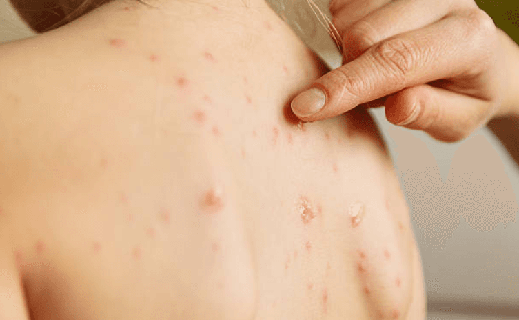 Parents urged to be wary as five measles cases confirmed in Dublin Parents urged to be wary as five measles cases confirmed in Dublin