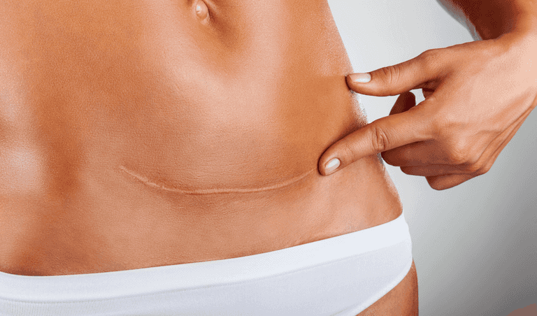 C-section recovery: We asked C-section mums to share their best tips and tricks C-section recovery: We asked C-section mums to share their best tips and tricks