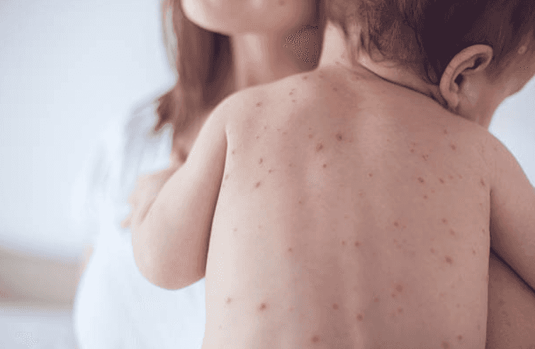 The HSE has confirmed a measles outbreak in Dublin City The HSE has confirmed a measles outbreak in Dublin City