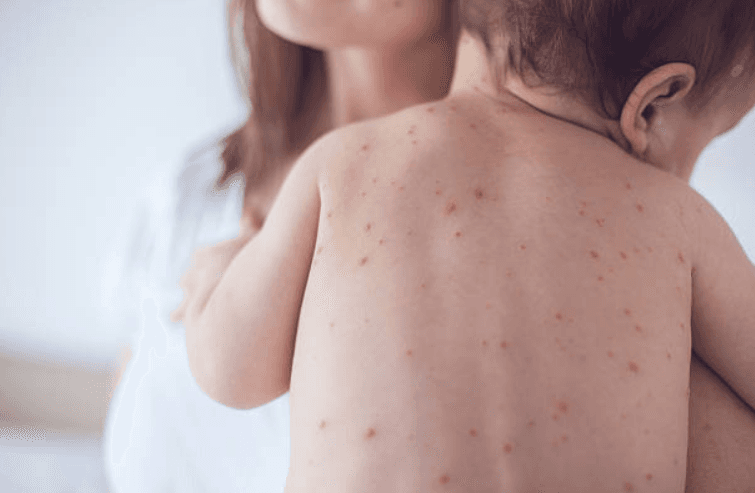 The HSE has confirmed a measles outbreak in Dublin City The HSE has confirmed a measles outbreak in Dublin City