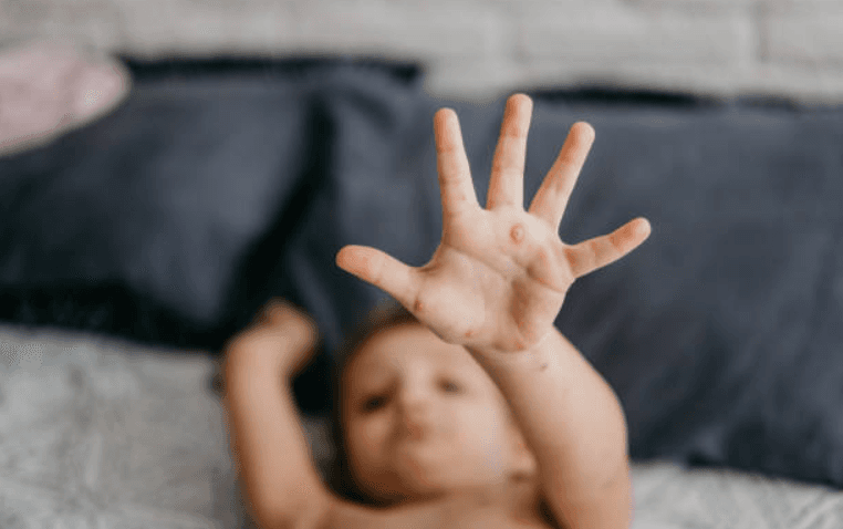 Parents in New York are holding ‘measles parties’ to expose unvaccinated kids Parents in New York are holding ‘measles parties’ to expose unvaccinated kids