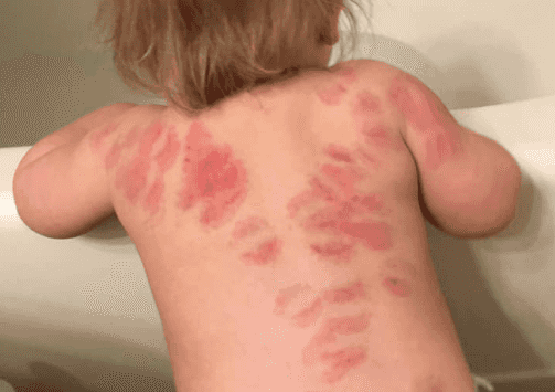 Mum’s horror at finding at least 25 bite marks on daughter’s body after picking her up from nursery Mum’s horror at finding at least 25 bite marks on daughter’s body after picking her up from nursery