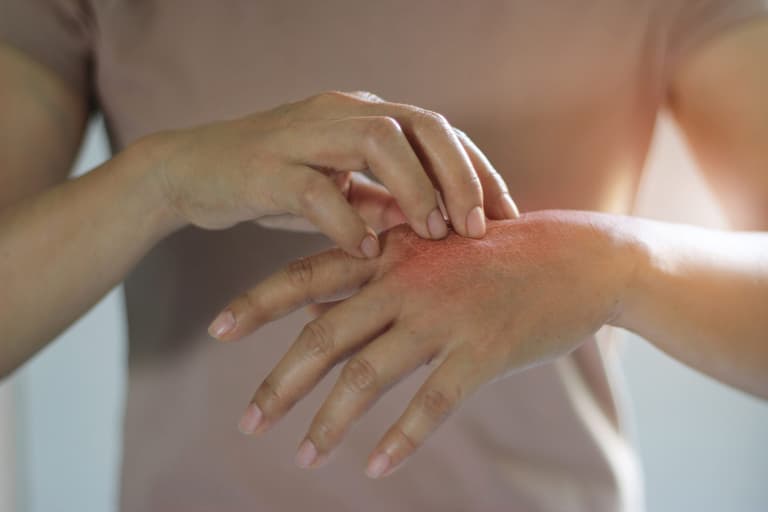 Psoriasis Awareness Month: Top 10 questions about the skin condition answered Psoriasis Awareness Month: Top 10 questions about the skin condition answered
