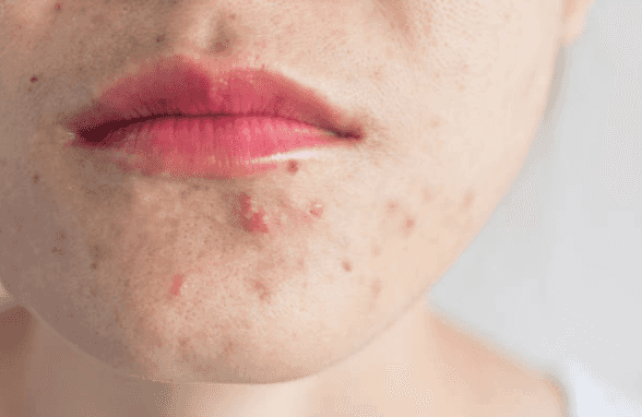 6 steps for treating acne in adulthood, according to a skin therapist 6 steps for treating acne in adulthood, according to a skin therapist
