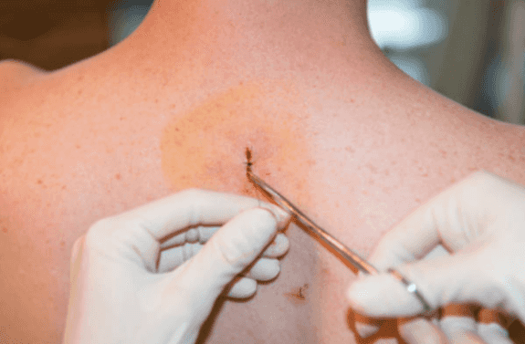 “I never thought it would be cancer”: Stage 4 melanoma patient recalls receiving her diagnosis “I never thought it would be cancer”: Stage 4 melanoma patient recalls receiving her diagnosis