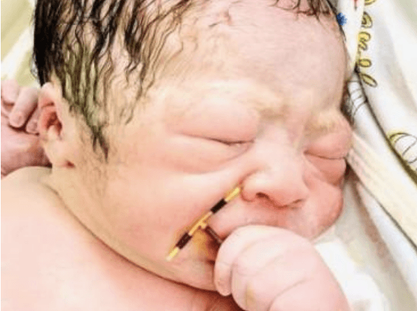 Doctors were shocked to find baby boy born clutching his mum’s contraceptive coil in his hand Doctors were shocked to find baby boy born clutching his mum’s contraceptive coil in his hand