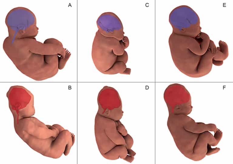 Women give birth in MRI to show baby’s head change shape in labour Women give birth in MRI to show baby’s head change shape in labour