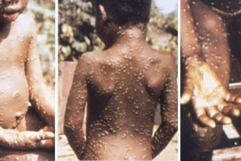 What is Monkeypox? Another rare virus has hit the UK What is Monkeypox? Another rare virus has hit the UK