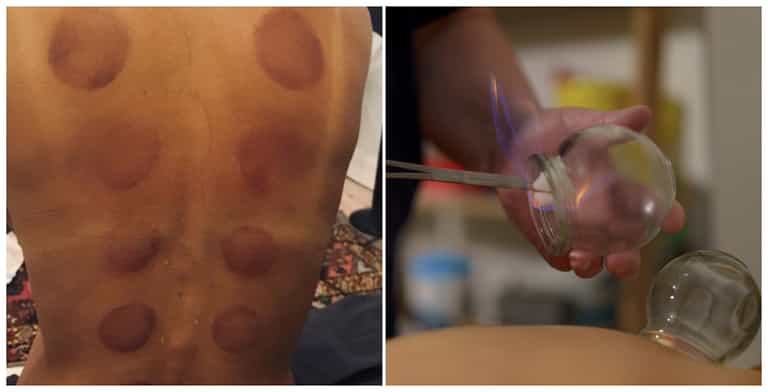 I tried the cupping therapy popular with celebrities – and here is what happened I tried the cupping therapy popular with celebrities – and here is what happened