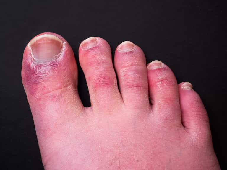 Did you get ‘Covid toes?’ Research shows new side effect of virus Did you get ‘Covid toes?’ Research shows new side effect of virus
