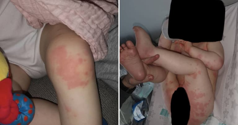 Cork mam warns parents after 1-year-old son is hospitalised with Covid-related rash Cork mam warns parents after 1-year-old son is hospitalised with Covid-related rash