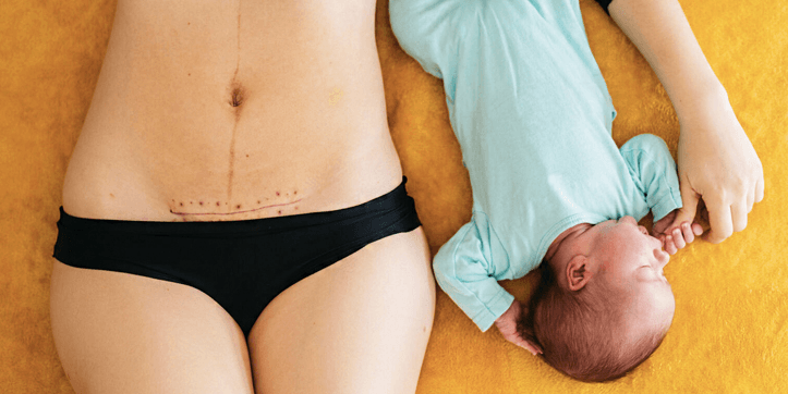 The effects of C-sections last long after baby is born a new study has found The effects of C-sections last long after baby is born a new study has found