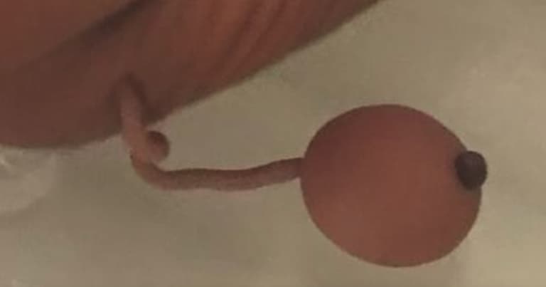 Premature newborn born with human tail Premature newborn born with human tail