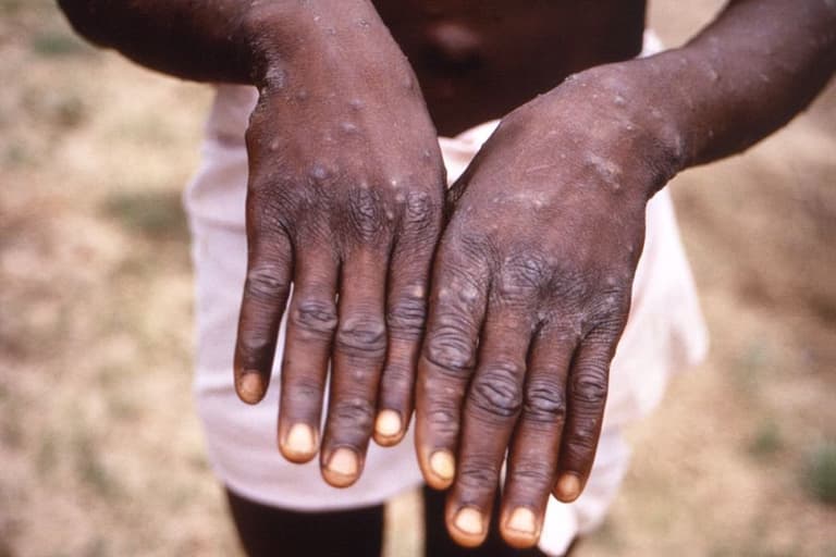 Parents told not to worry about monkeypox as cases are rare in children Parents told not to worry about monkeypox as cases are rare in children