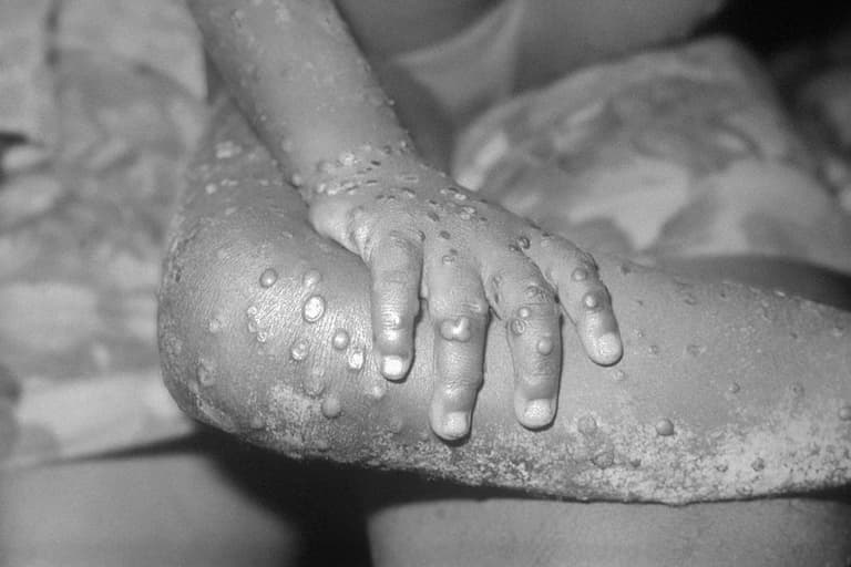 What exactly is monkeypox and is it dangerous? What exactly is monkeypox and is it dangerous?