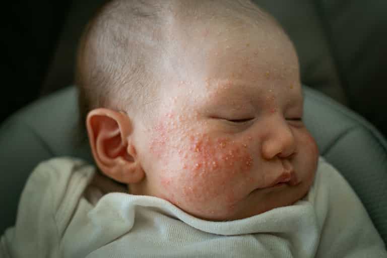 ‘This budget-friendly soap cleared up my daughter’s eczema in one week’ ‘This budget-friendly soap cleared up my daughter’s eczema in one week’