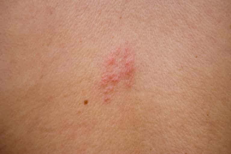 HSE issues shingles warning – here are the symptoms to look out for HSE issues shingles warning – here are the symptoms to look out for