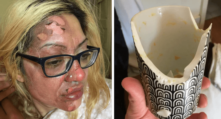 Mum left in ‘agony’ after following viral TikTok poached egg ‘hack’ Mum left in ‘agony’ after following viral TikTok poached egg ‘hack’