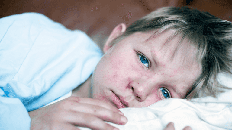 How you can protect you and your family against measles as cases increase How you can protect you and your family against measles as cases increase